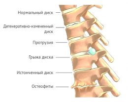 Реферат: Сколиоз. Хронический фарингит. Плоскостопие