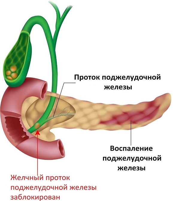 Лечение хронического панкреатита | Kyiv Clinic